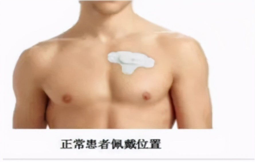 穿戴式72小時動態心電圖，你知道是什么嗎？