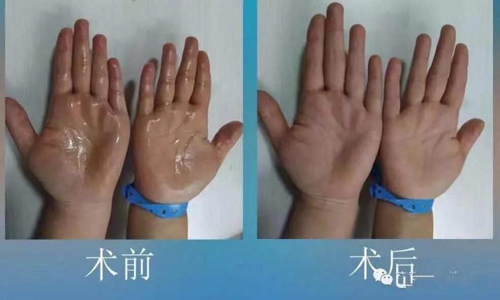 雙手四季“滴汗如雨”？微創手術來解憂