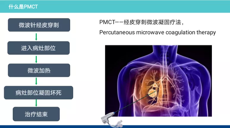 江西省胸科醫院腫瘤二科完成一例惡性腫瘤肺轉移高難度微波消融術
